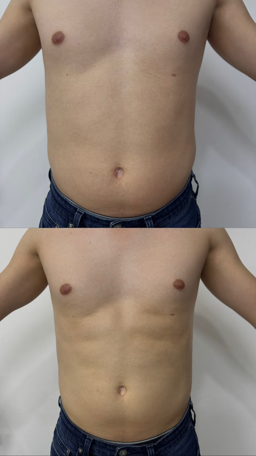 Antes y después de un tratamiento corporal reafirmante