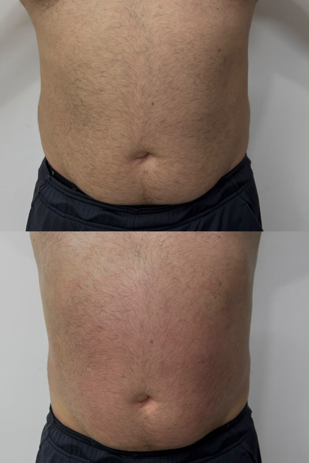 Antes y después de un tratamiento corporal de abdomen